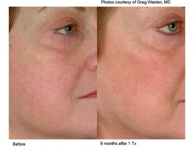 laser-vein-therapy1