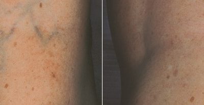 laser-vein-therapy2