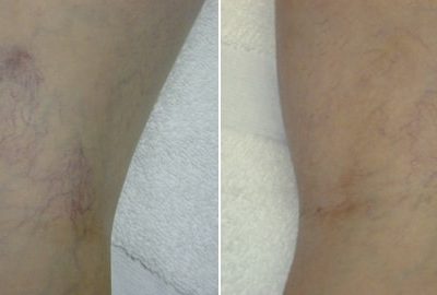 laser-vein-therapy3