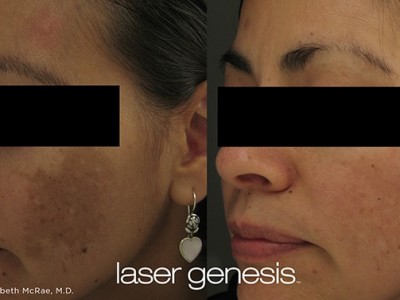 xeo-lasergenesis-1