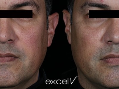 xeo-lasergenesis-3