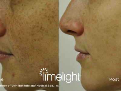 xeo-limelight-before-after1