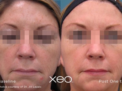 xeo-limelight-before-after2