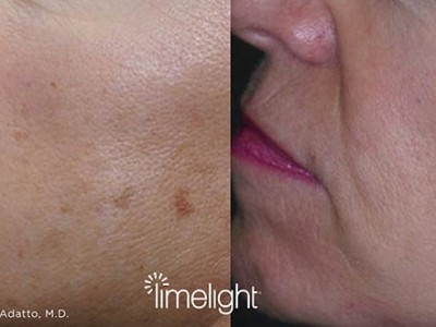 xeo-limelight-before-after3